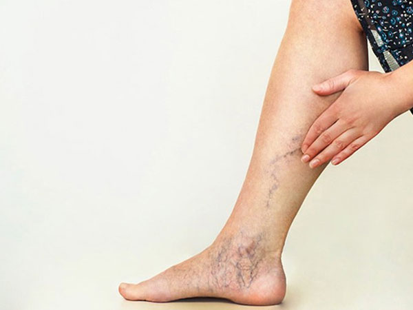 Xoa bóp hỗ trợ chữa giãn tĩnh mạch chân